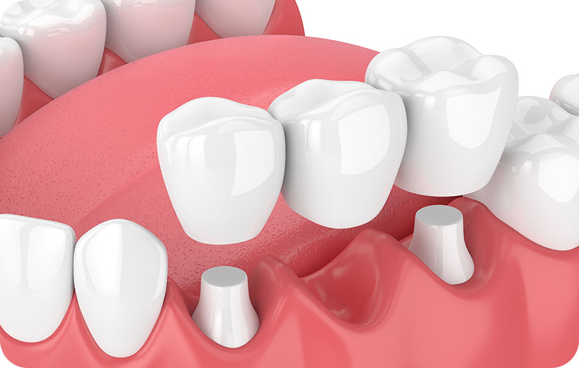 Dental Bridges | Neighbourhood Dental | General & Family Dentist | Red Deer