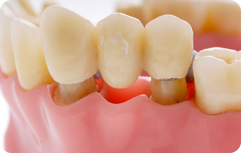 Dental Bridges | Neighbourhood Dental | General & Family Dentist | Red Deer