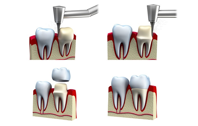 Dental Crowns | Neighbourhood Dental | General & Family Dentist | Red Deer