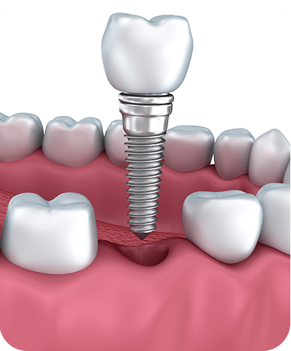 Dental Implants | Neighbourhood Dental | General & Family Dentist | Red Deer