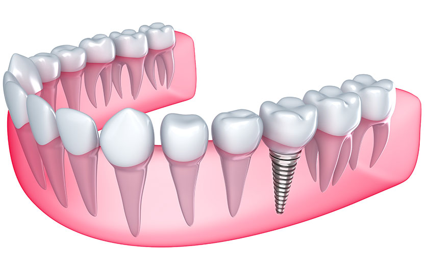 Dental Implants | Neighbourhood Dental | General & Family Dentist | Red Deer