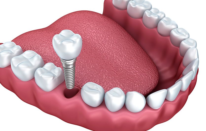 Dental Implants | Neighbourhood Dental | General & Family Dentist | Red Deer