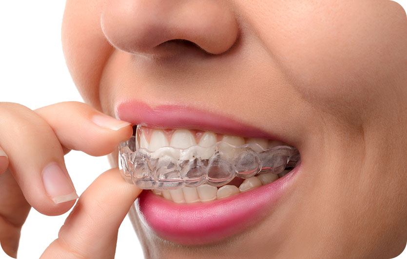 Orthodontics | Invisalign | Neighbourhood Dental | General & Family Dentist | Red Deer