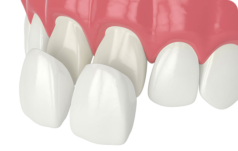 Porcelain Veneers | Neighbourhood Dental | General & Family Dentist | Red Deer