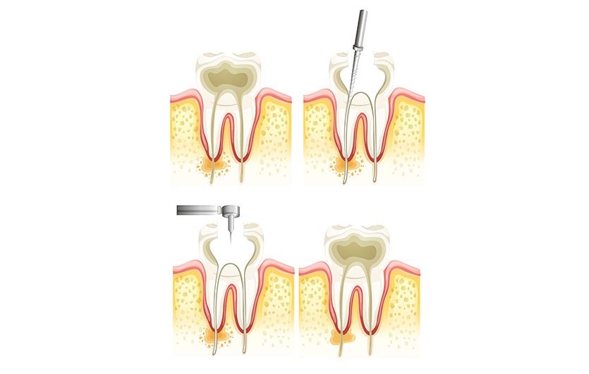 Root Canal Therapy | Neighbourhood Dental | General & Family Dentist | Red Deer