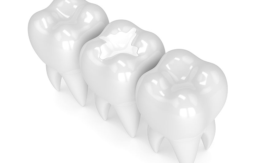 White Fillings | Neighbourhood Dental | General & Family Dentist | Red Deer